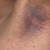 Acanthosis Nigricans in the armpit. Acanthosis Nigricans in the armpit.