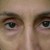 Swelling seen on the skin under the eye together with loose and saggy under-eye skin are common symptoms of Bags under eye. Swelling seen on the skin under the eye together with loose and saggy under-eye skin are common symptoms of Bags under eye.