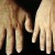 #6: Acromegalic enlargement of hand. #6: Acromegalic enlargement of hand.