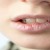 #1: Mouth Dryness is the common symptom of Xerostomia. #1: Mouth Dryness is the common symptom of Xerostomia.