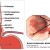 #3: Barrett's Esophagus which is a precancerous change in the structure of the lining of your esophagus. #3: Barrett's Esophagus which is a precancerous change in the structure of the lining of your esophagus.
