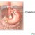 #1: Nissen fundoplication. #1: Nissen fundoplication.