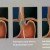 #3: Stretta Procedure which is hating the esophageal tissue to make it fibrose. #3: Stretta Procedure which is hating the esophageal tissue to make it fibrose.