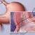 Another illustration of Fundoplication. Another illustration of Fundoplication.