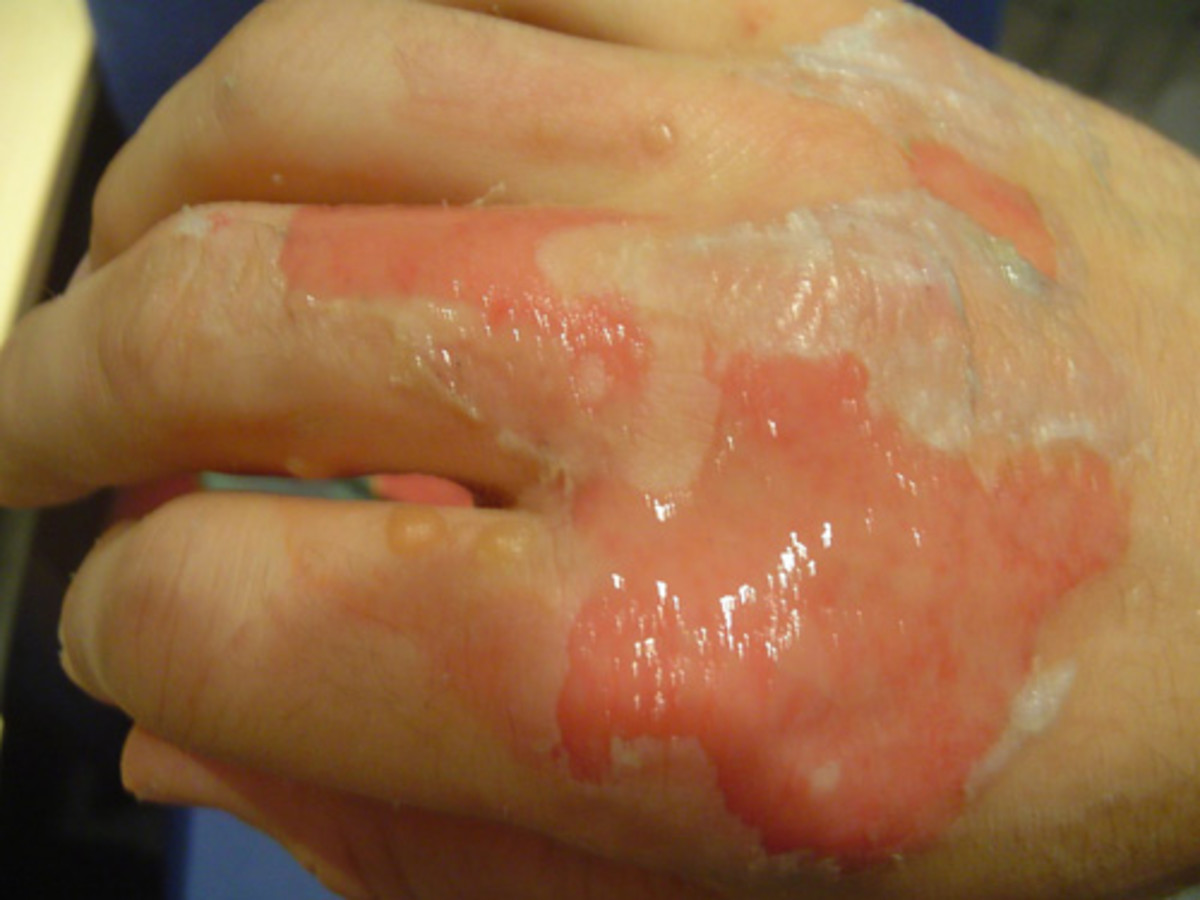A second degree burn caused by glue at 145 °C