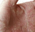 How to Get Rid of Psoriasis Fast | Natural Remedies for Psoriasis