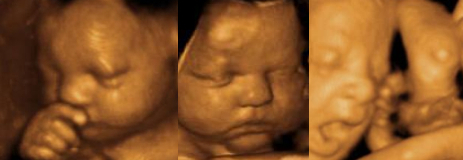 3d ultrasound 28 - 32 weeks