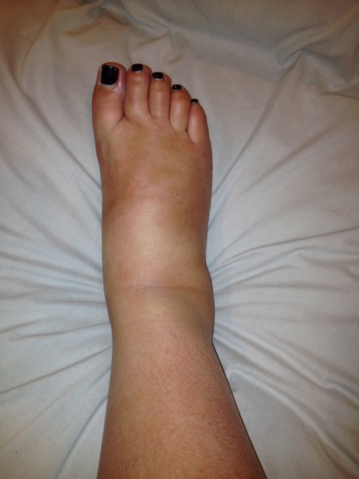 A swollen ankle, foot & toes.
