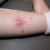 #4: Single large boil of herpes zoster on the leg with few boils scattered around. #4: Single large boil of herpes zoster on the leg with few boils scattered around.