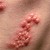 #1: a photo showing a group of boils on the back. #1: a photo showing a group of boils on the back.