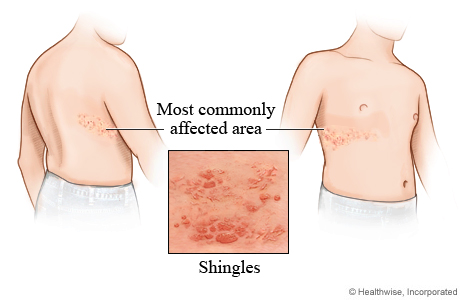 Shingles (Herpes Zoster) | HubPages chicken pox blister diagram 