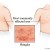 #5: The most common sites affected with Shingles. #5: The most common sites affected with Shingles.