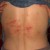 #7: Groups of herpes boils located on both sides of the back. #7: Groups of herpes boils located on both sides of the back.