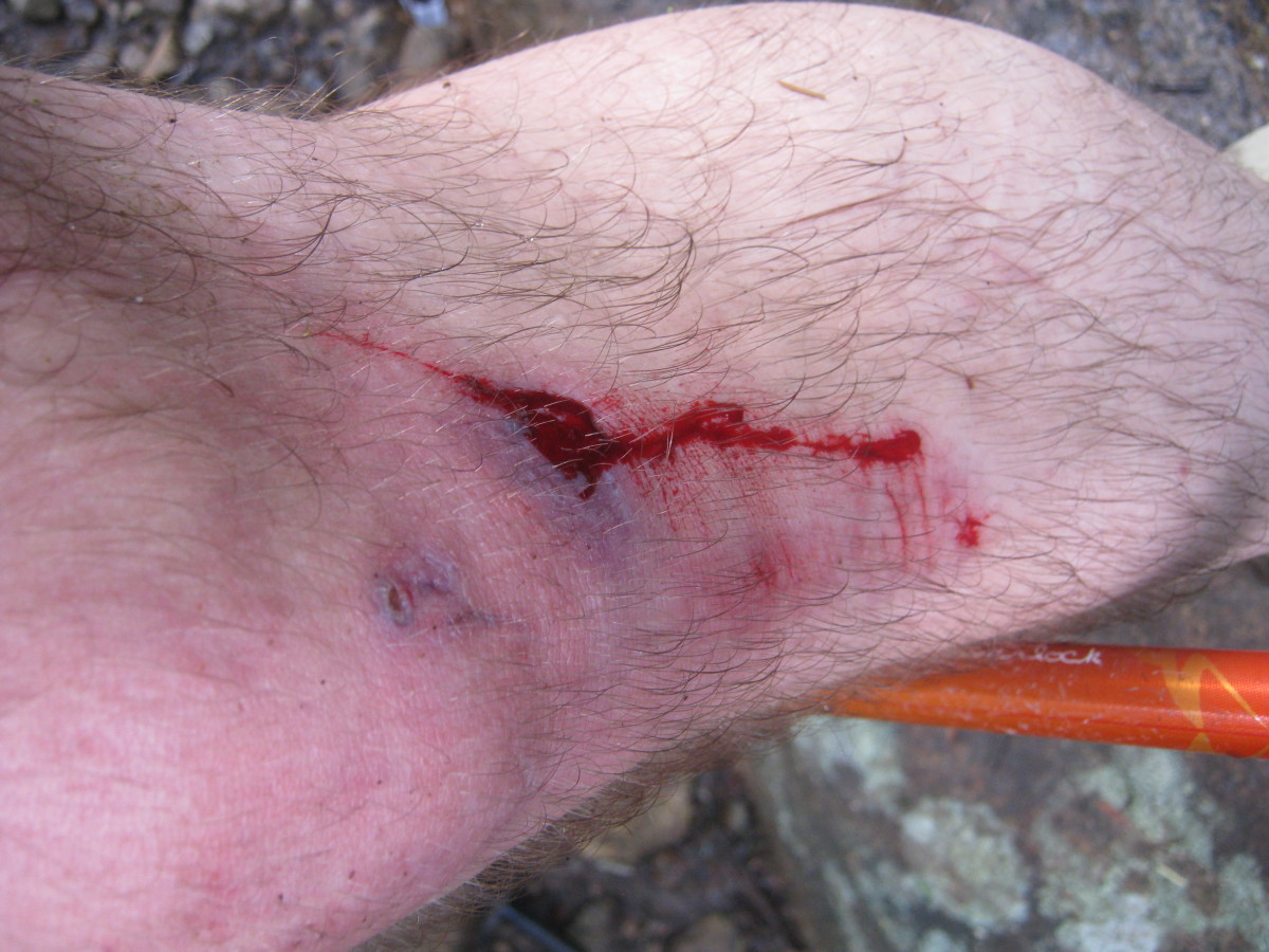 Knowing when enough is enough and when to turn around is an important skills for hikers.  First aid is also important.  