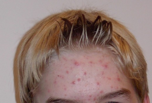 Adolescent acne