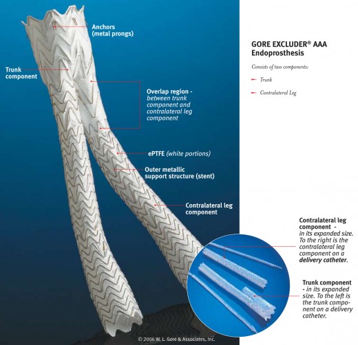 Abdominal Aortic Aneurysm Endoprothesis - Cutout shows the device still tightly wound on the delivery catheter. The balance of the illustrations shows the prosthesis expanded  as it will be after installation within the aorta