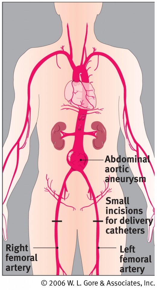 Diagram of the procedure in which the endoprothesis is inserted within the balooning abdominal aorta