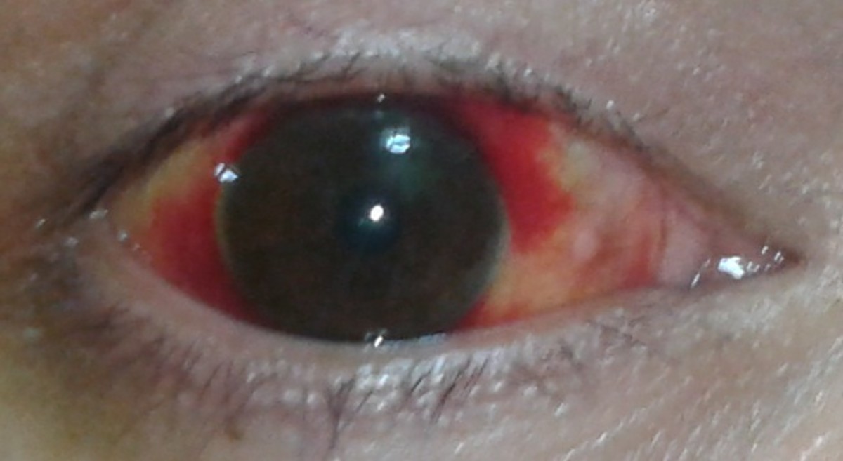What causes broken blood vessels in eyes?
