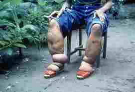 Elephantiasis, another awful disease that can be mozzie-borne