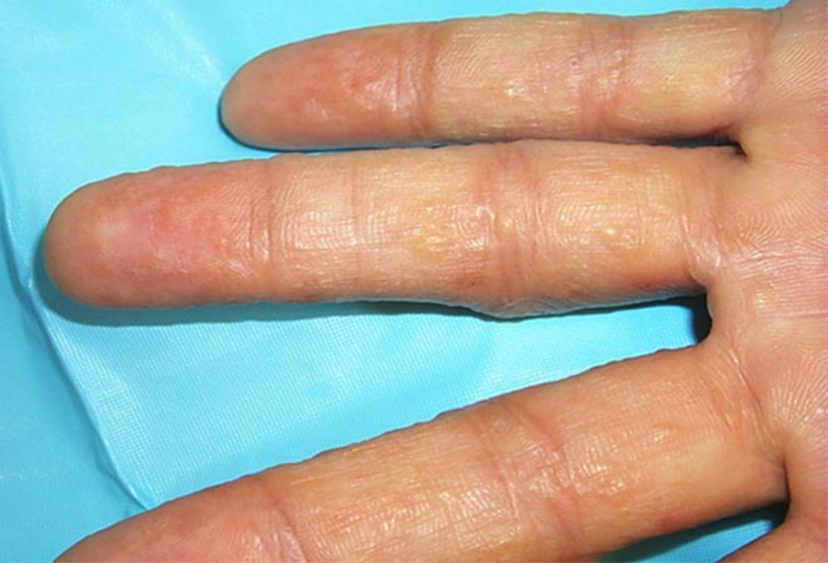 What is the treatment for hand eczema?