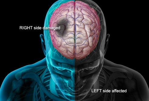Damage in the right side of the brain causes left-sided weakness and other problems on the left side of the body.