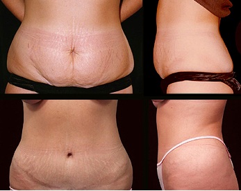 Abdominoplasty or tummy tuck to reduce excess skin and fat in the tummy area