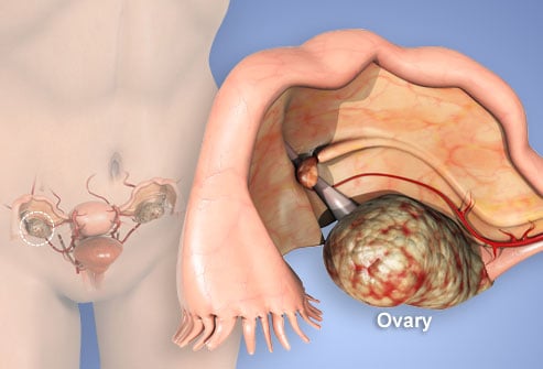 Ovarian Cancer Stage four Prognosis