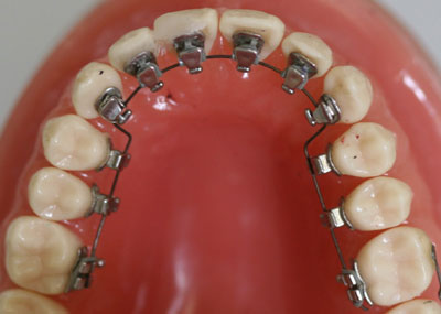 This is what lingual braces look like.