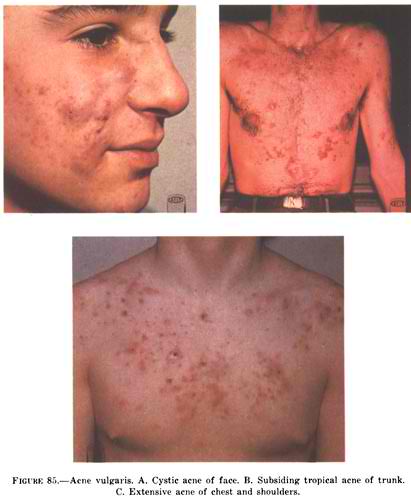 Ance Vulgaris -courtesy of Wikimedia Commons