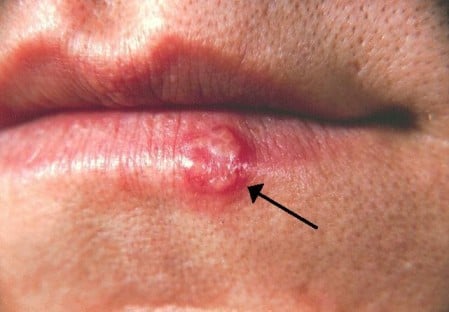 This is what just one herpes simplex sore looks like on your mouth. Imagine 10 to 50 of them you know where.