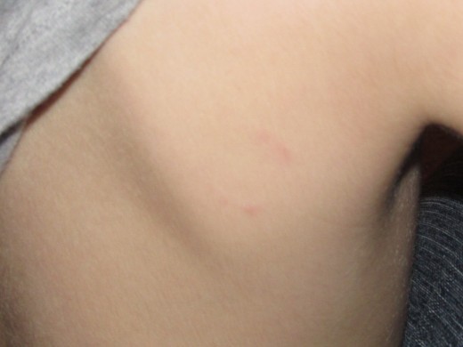 Jacob's bite mark on his shoulder 