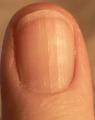Your fingernails tell a great deal about your overall health and well being. For example if you have rigid and vertical lines as well as the absence, or lack of milky white half moons beneath your nail beds. This can indicate a B-12 deficiency