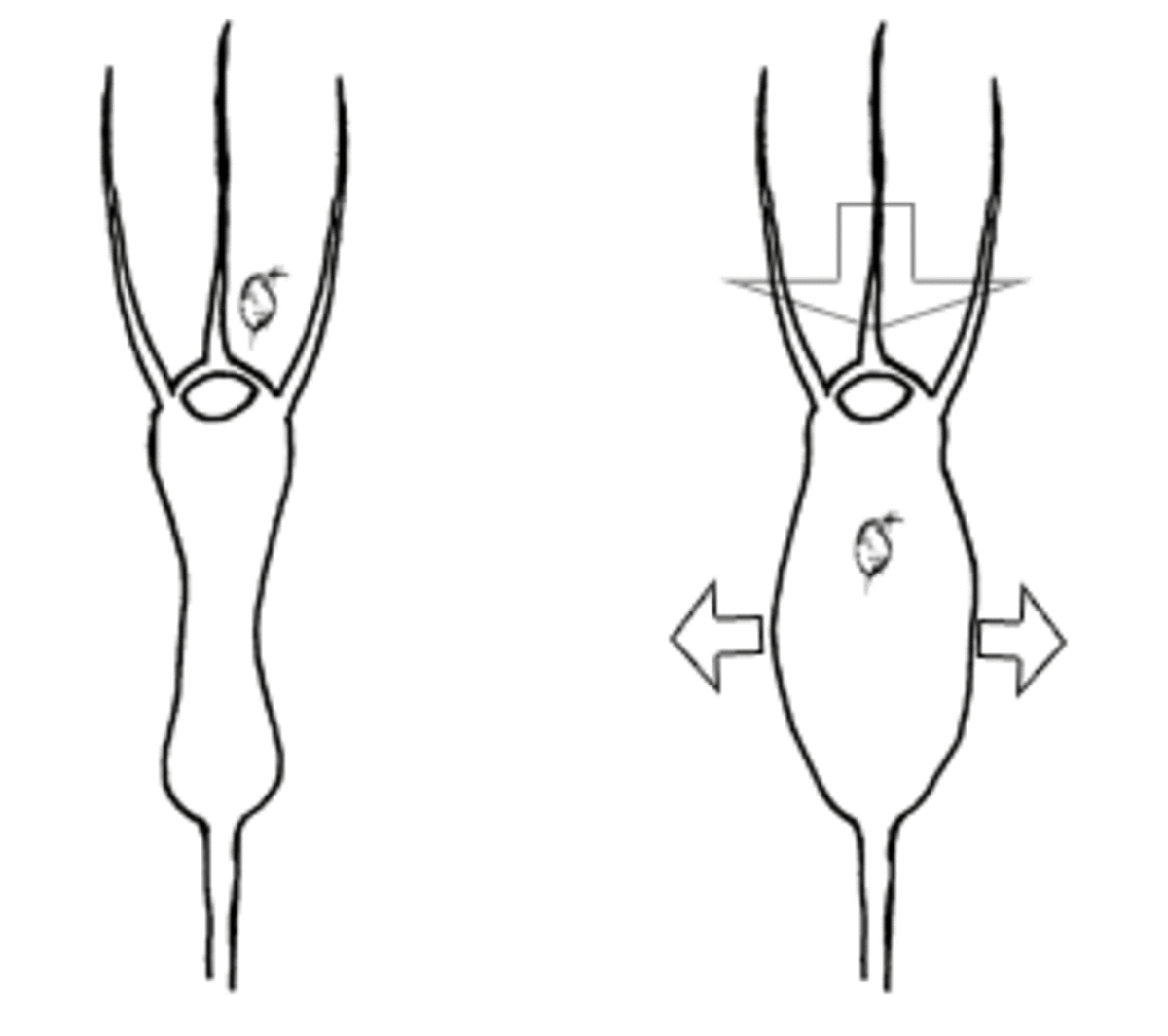 Bladder expansion and trapping mechanism.