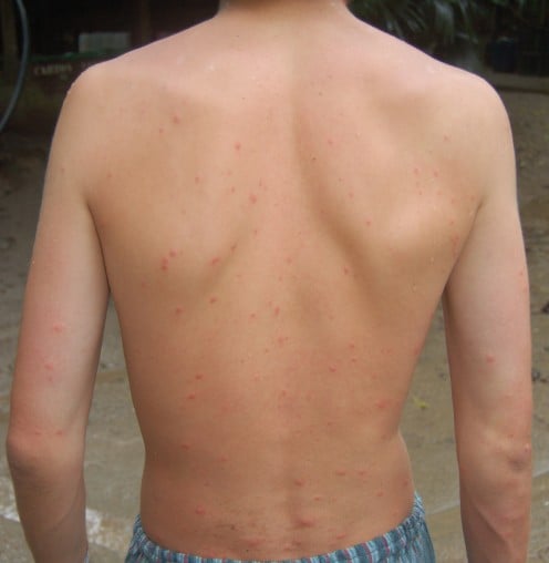 Mosquitoes and other bug bites can cause itchy skin.