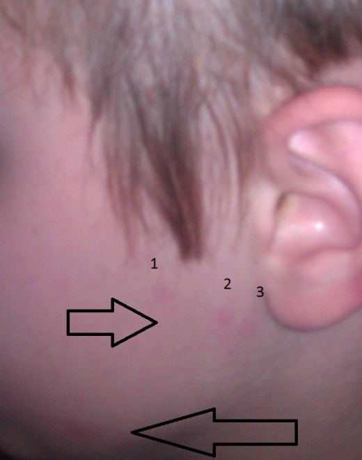 Pictures of Bed Bug Bites on Kids | Dengarden