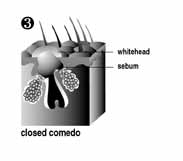 "If the plug is below the skin surface, it is called a whitehead, or closed comedo."