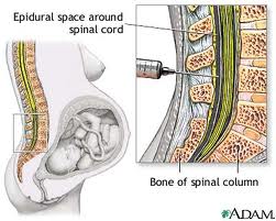 How an epidural is administered