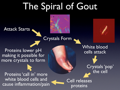 This is what is happening on the inside of a foot with gout.