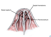 Image showing a nasal septal hematoma
