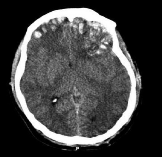 Brain Damage: CT Cat scan showing cerebral contusions, hemorrhage within the hemispheres, subdural hematoma, and skill fractures