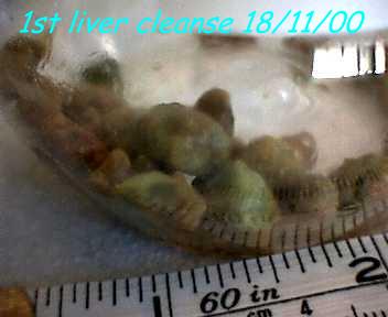 Gallstones from my first liver flush. Twice yearly liver cleanse is recommended.