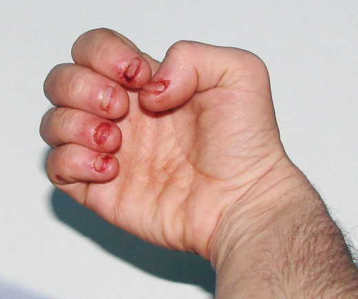 Obsessive Compulsive Disorder