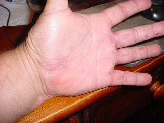 My Hand after 6 Months