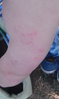 Pictures of Bed Bug Bites on Kids | Dengarden