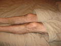 Restless Legs and RLS Treatment