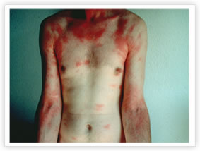 Rashes From Hairy Caterpillars