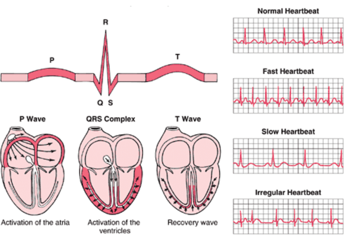 What are the types of irregular heart beats?