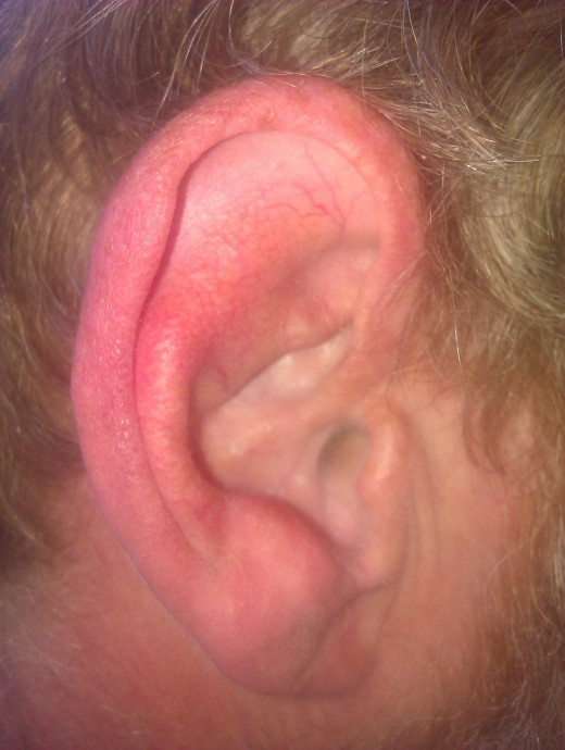 My husband's ear - he has been surfing for around 30 years and has a mild case of Surfer's Ear.  There are no visible symptoms.