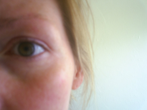 Dry eyes