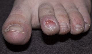 Hikers can get runner's toe if their toes hit the front of the boot while walking.